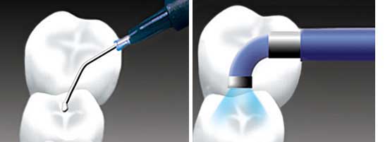 مراحل انجام فیشور سیلنت دندان