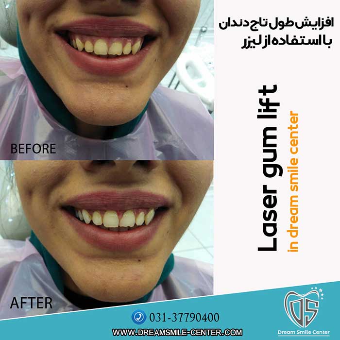 لیزر دندانپزشکی اصفهان