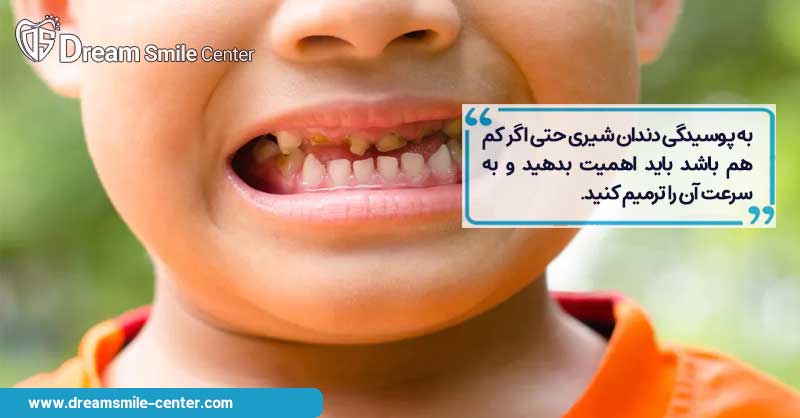 اهمیت درمان پوسیدگی دندان کودک