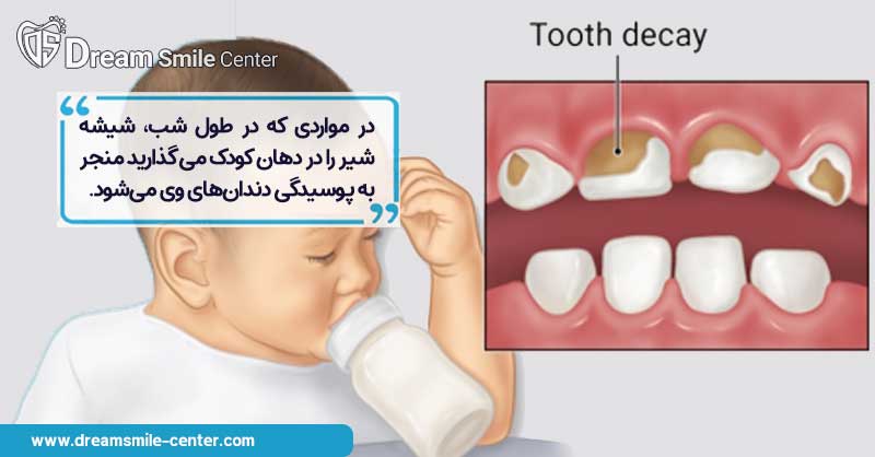 خراب شدن زود هنگام دندان کودک