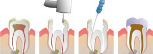 علت آبسه دندان بعد از عصب کشی