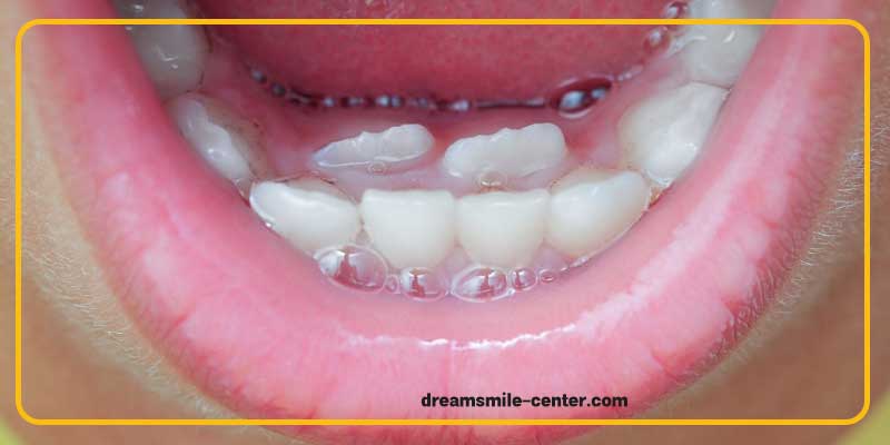 رویش دندان دائمی پشت دندان شیری | دکترفرشیده میرلوحی دندانپزشک کودکان