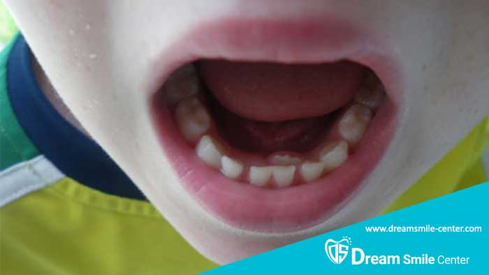 رویش دندان دائمی پشت دندان شیری