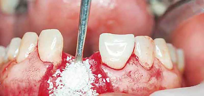 پبوند دندان
