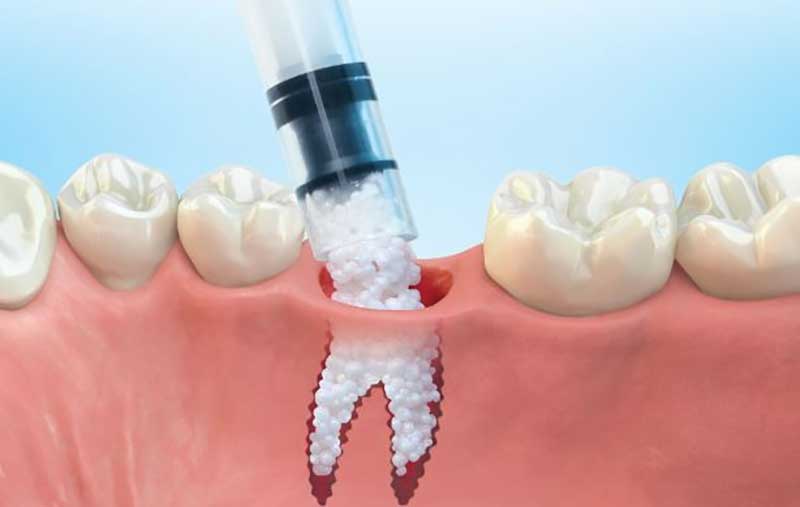 روش های پیوند دندان