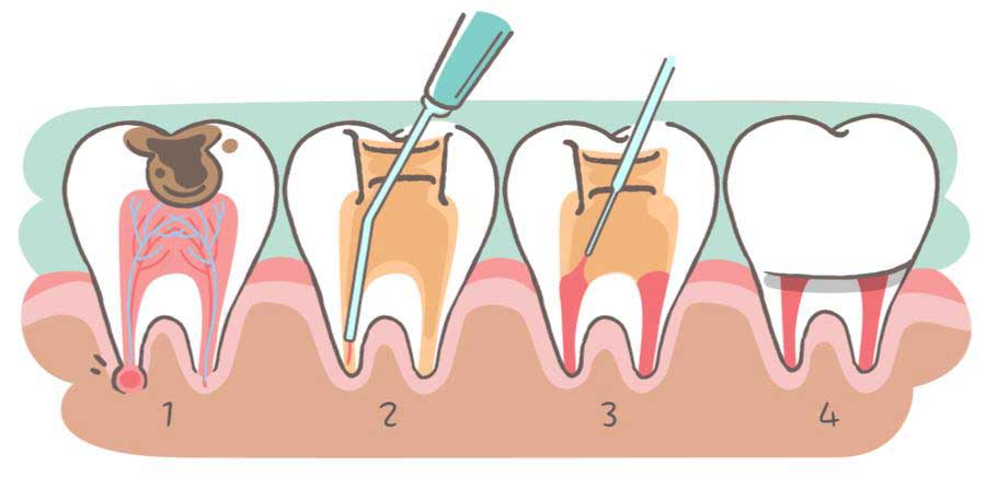 درمان التهاب دندان عصب کشی شده