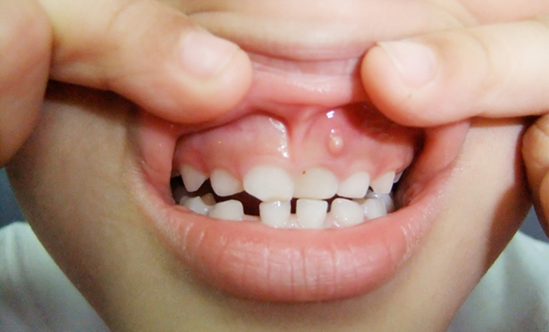 درمان آبسه دندان کودکان