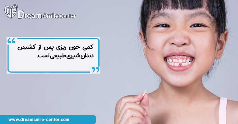 مراقبت‌های بعد از کشیدن دندان شیری کودک