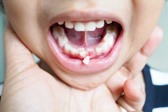 لب پر شدن دندان شیری کودک