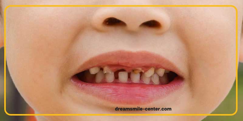 راههای پیشگیری از زود افتادن دندان شیری | دکترفرشیده میرلوحی دندانپزشک کودکان