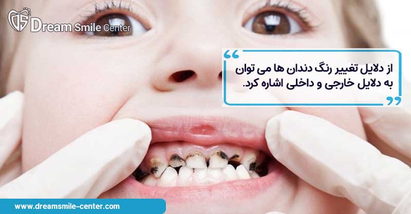 دلایل تغییر رنگ دندان کودکان
