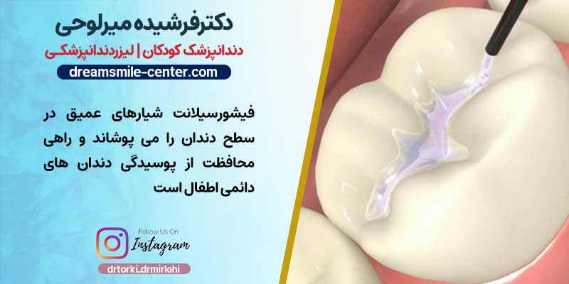 فیشورسیلانت راهی برای محافظت از پوسیدگی دندان های دائمی اطفال