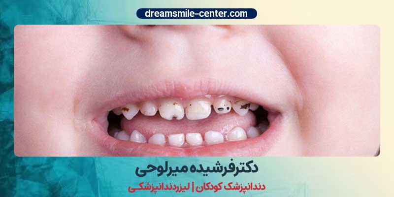 راههای پیشگیری از پوسیدگی در دندان شیری