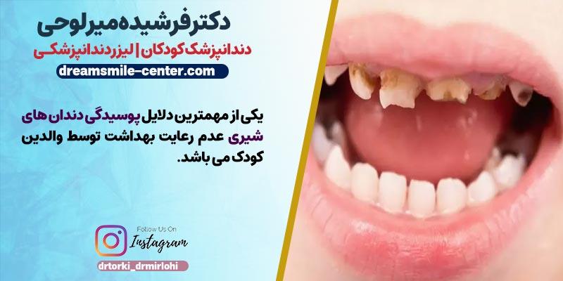 مهمترین دلیل پوسیدگی دندانهای شیری | دکتر فرشیده میرلوحی