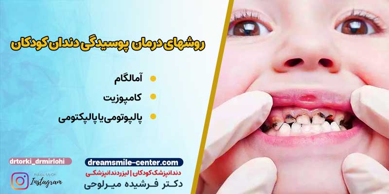 روشهای درمان پوسیدگی دندان کودکان| دکترفرشیده میرلوحی دندانپزشک کودکان