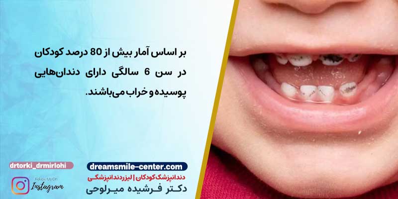 عکس پوسیدگی دندان کودکان | دکترفرشیده میرلوحی دندانپزشک کودکان