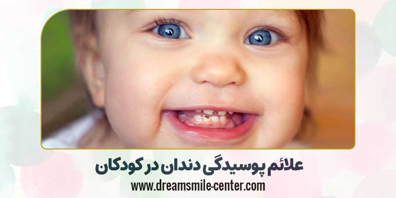 علائم پوسیدگی دندان کودکان | دکترفرشیده میرلوحی دندانپزشک کودکان