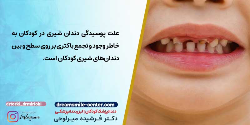 علت پوسیدگی دندان کودکان | دکترفرشیده میرلوحی دندانپزشک کودکان