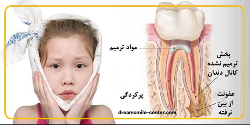 درد عصب کشی دندان شیری کودکان | دکترفرشیده میرلوحی دندانپزشک کودکان