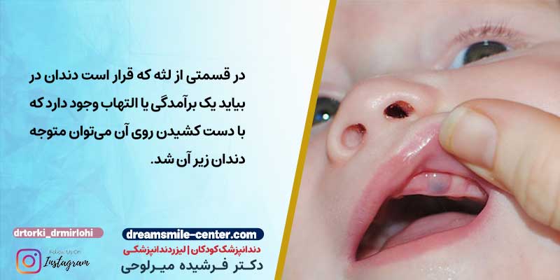 التهاب لثه هنگام دندان در اوردن کودکان| دکترفرشیده میرلوحی دندانپزشک کودکان