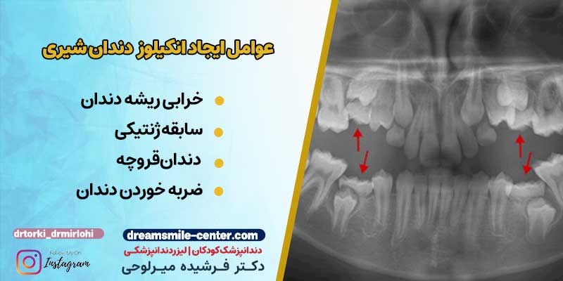 عوامل ایجاد آنکیلوز دندان