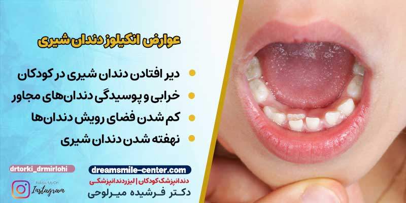 عوارض انکیلوز دندان شیری
