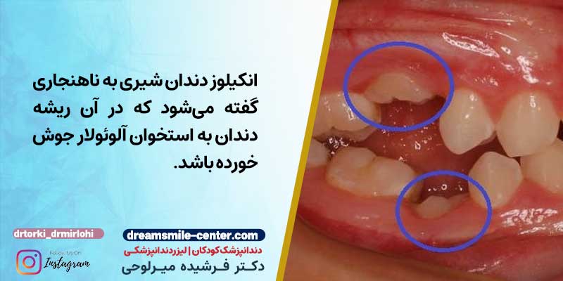 آنکیلوز دندان | جوش خوردن دندان به فک