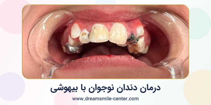 درمان دندان نوجوان ۱۲ ساله با بیهوشی در اصفهان | مرکز لبخند رویایی