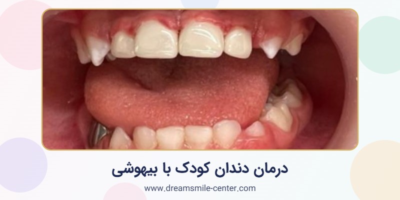 درمان دندان کودک ۲.۵ ساله با بیهوشی در اصفهان | مرکز لبخند رویایی